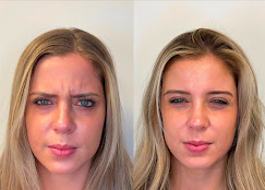 Before — Frown Lines